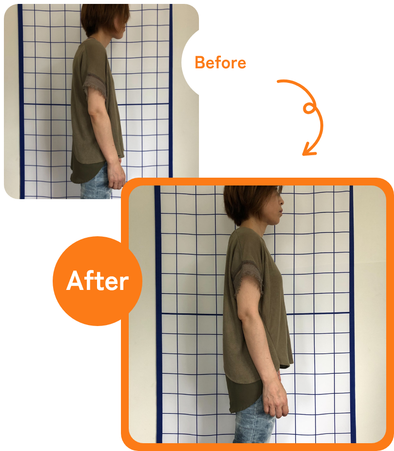 猫背の悩み Before→After