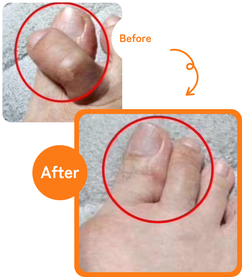 脚の変形による悩み Before→After